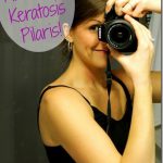 how I fixed my keratosis pilaris